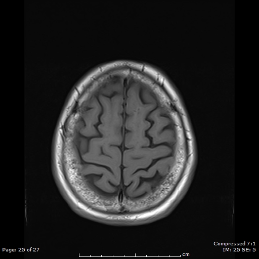File:Anterior temporal lobe perivascular space (Radiopaedia 88283-104914 Axial T1 25).jpg