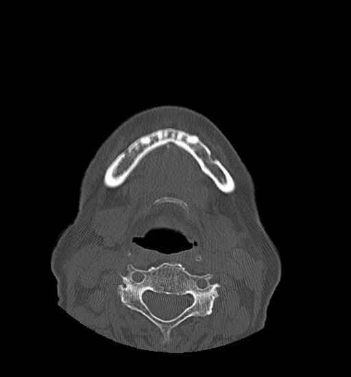 File:Anterior temporomandibular joint dislocation (Radiopaedia 59430-66784 Axial non-contrast 54).jpg