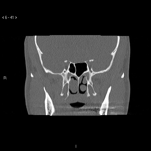 File:Antrochoanal Polyp (Radiopaedia 70510-80631 Coronal bone window 30).jpg