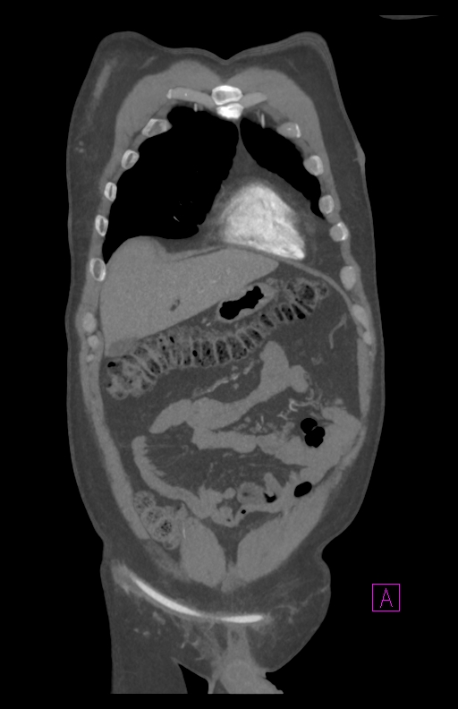 Aortectomy and axillary-bifemoral bypass (Radiopaedia 28303-28545 C 22).jpg