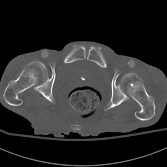Aortic aneurysm with spinal destruction (Radiopaedia 42301-45410 Axial bone window 112).jpg