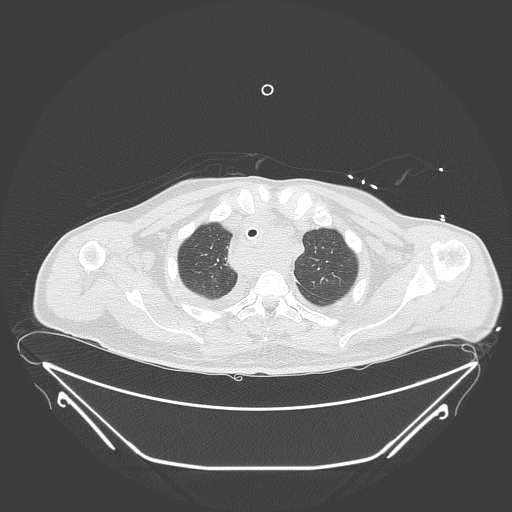 Aortic arch aneurysm (Radiopaedia 84109-99365 Axial lung window 64).jpg