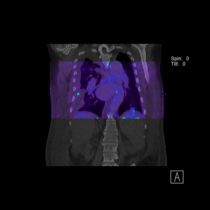 Aortic arch graft infection (FDG PET-CT) (Radiopaedia 71975-82438 D 58).jpg