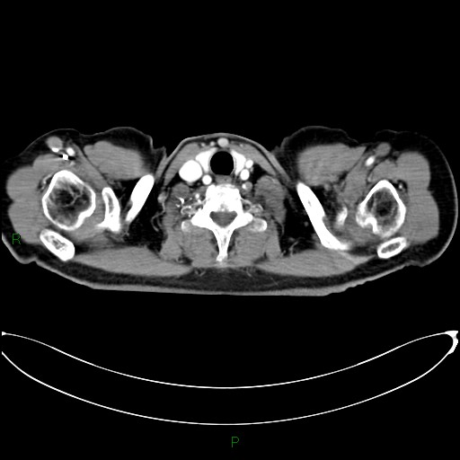 Aortic arch origin of left vertebral artery (Radiopaedia 46327-50737 Axial post contrast 1).jpg