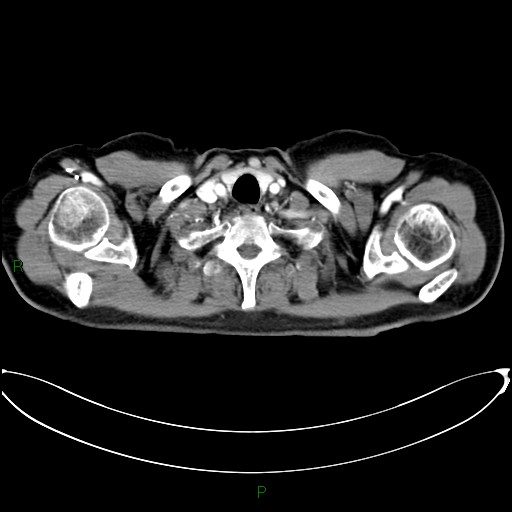 File:Aortic arch origin of left vertebral artery (Radiopaedia 46327-50737 Axial post contrast 7).jpg
