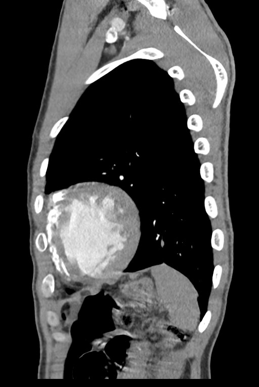 Aortic coarctation with aneurysm (Radiopaedia 74818-85828 B 132).jpg