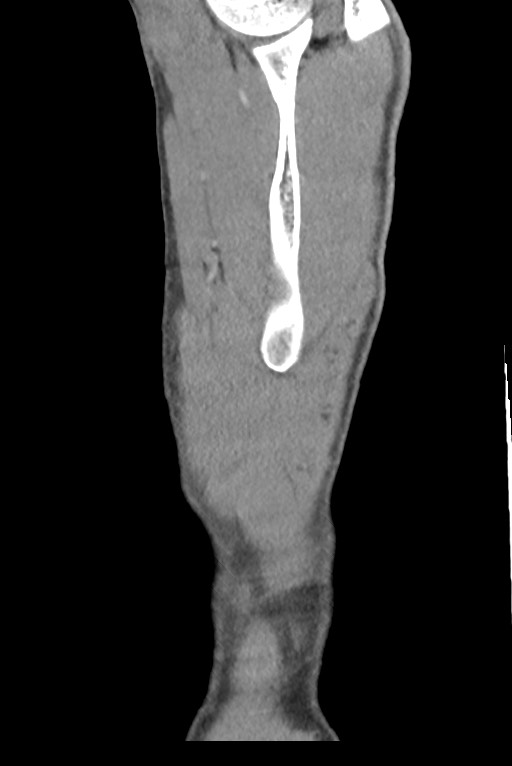 Aortic coarctation with aneurysm (Radiopaedia 74818-85828 B 154).jpg