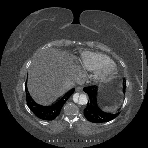 Aortic dissection- Stanford A (Radiopaedia 35729-37268 B 14).jpg
