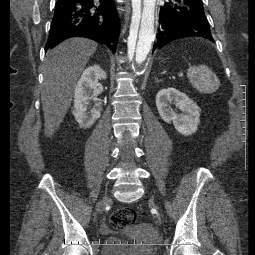 File:Aortic dissection- Stanford A (Radiopaedia 35729-37268 F 15).jpg