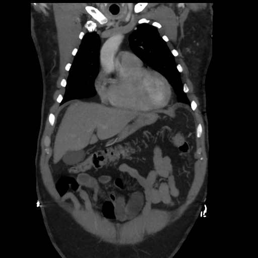 File:Aortic dissection- Stanford A (Radiopaedia 37759-39664 Coronal C+ delayed 9).png