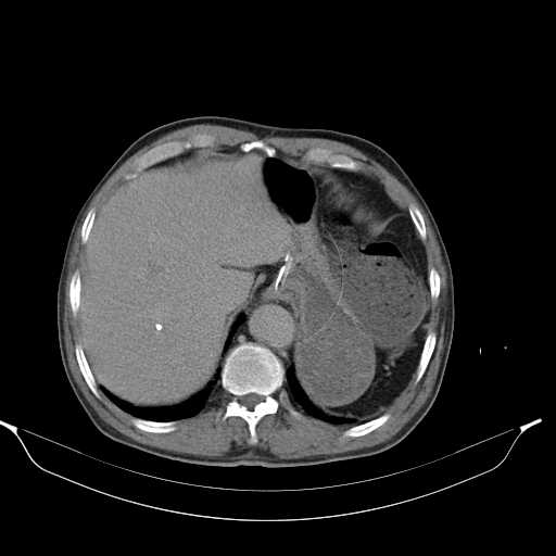 File:Aortic dissection- Stanford type A (Radiopaedia 22085-22085 Axial C+ delayed 9).jpg