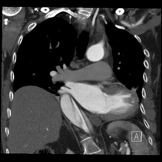 Aortic dissection (CTPA) (Radiopaedia 75506-86750 B 37).jpg