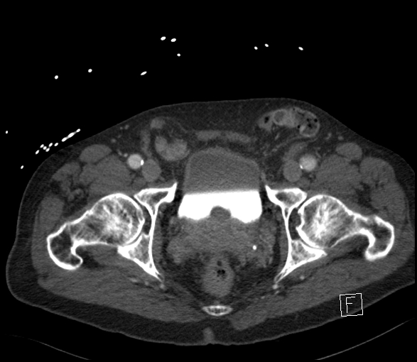 Aortic dissection (CTPA) (Radiopaedia 75506-86750 E 145).jpg