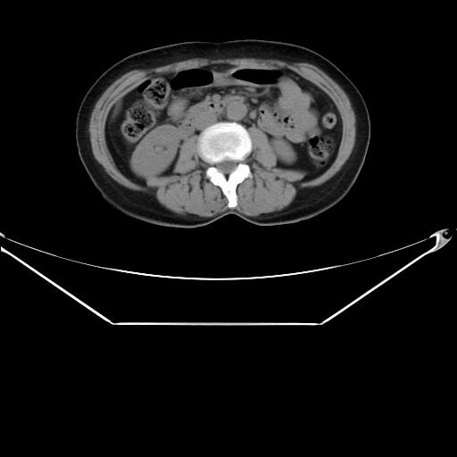 File:Aortic dissection (Radiopaedia 25350-25604 B 51).jpg