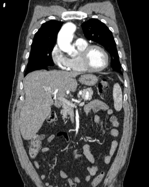 Aortic dissection (Radiopaedia 44411-48061 A 6).jpg