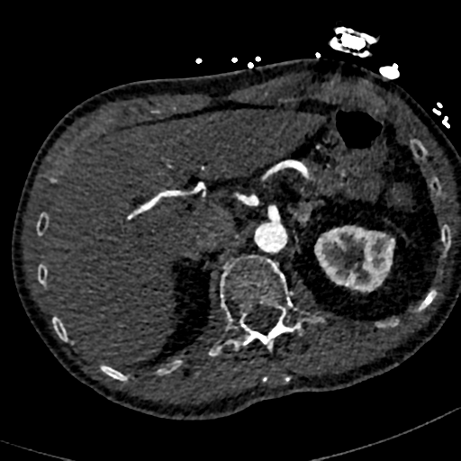 File:Aortic dissection - DeBakey type II (Radiopaedia 64302-73082 A 91).png