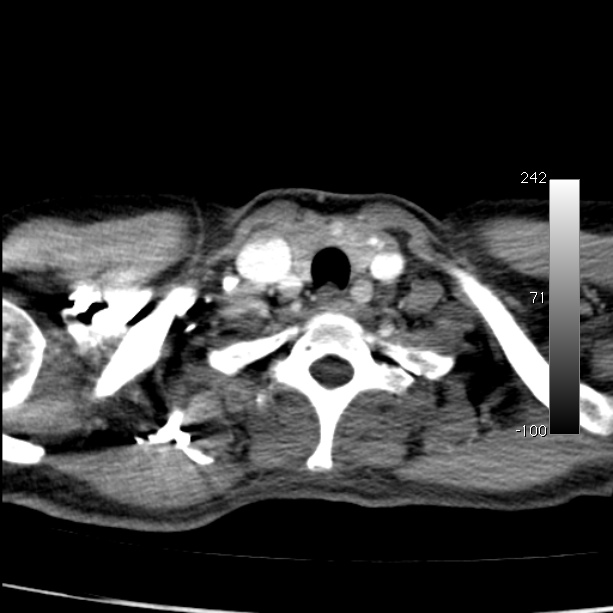 Aortic dissection - Stanford type A (Radiopaedia 29247-29659 A 6).jpg