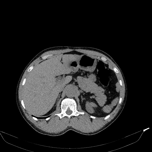 Aortic dissection - Stanford type A (Radiopaedia 83418-98500 Axial non-contrast 45).jpg