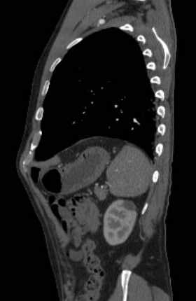File:Aortic dissection - Stanford type B (Radiopaedia 73648-84437 C 30).jpg