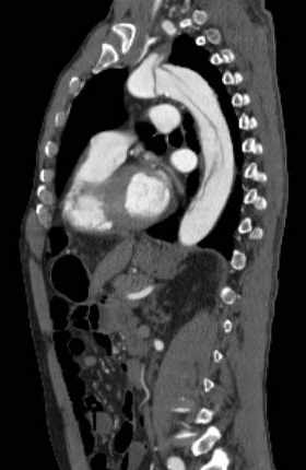 File:Aortic dissection - Stanford type B (Radiopaedia 73648-84437 C 62).jpg