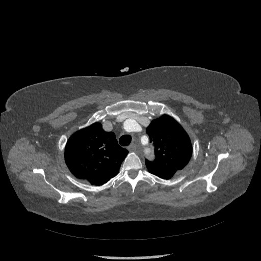 Aortic dissection - Stanford type B (Radiopaedia 88281-104910 A 10).jpg