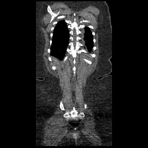 File:Aortic dissection - Stanford type B (Radiopaedia 88281-104910 B 81).jpg