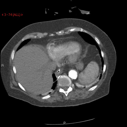 Aortic intramural hematoma (Radiopaedia 27746-28001 A 74).jpg
