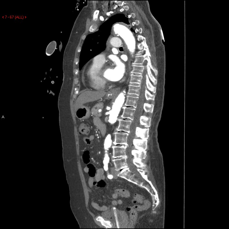 Aortic intramural hematoma (Radiopaedia 27746-28001 C 36).jpg
