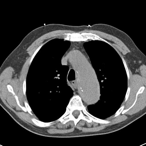 Aortic intramural hematoma (Radiopaedia 31139-31838 Axial non-contrast 18).jpg