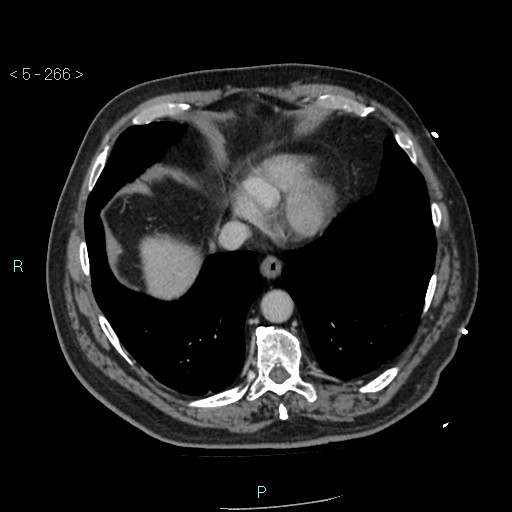 Aortic intramural hematoma (Radiopaedia 48463-53380 C 120).jpg