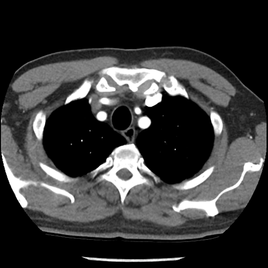 Aortic intramural hematoma (type B) (Radiopaedia 79323-92387 B 7).jpg