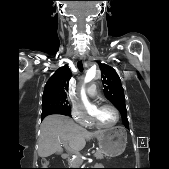 Aortic intramural hematoma with dissection and intramural blood pool (Radiopaedia 77373-89491 C 26).jpg