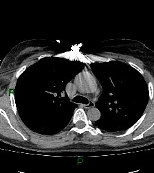File:Aortic valve endocarditis (Radiopaedia 87209-103485 Axial non-contrast 39).jpg
