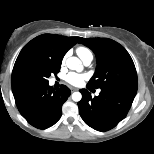 Aortic valve non-coronary cusp thrombus (Radiopaedia 55661-62189 B 26).png