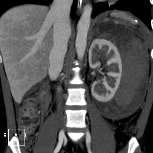 File:Aorto-left renal vein fistula (Radiopaedia 45534-49628 B 39).jpg