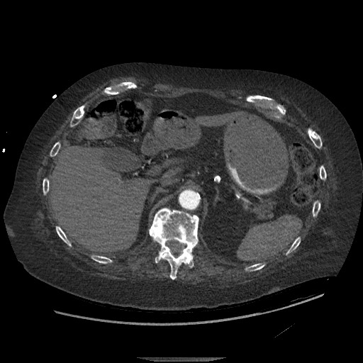 Aortoesophageal fistula with endovascular repair (Radiopaedia 73781-84592 Axial C+ CTPA 179).jpg