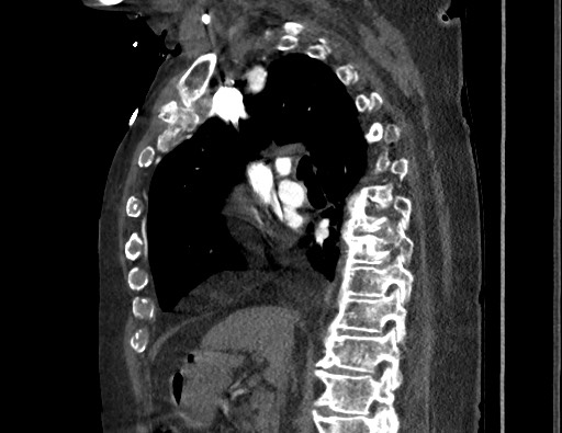 Aortoesophageal fistula with endovascular repair (Radiopaedia 73781-84592 Sagittal C+ CTPA 81).jpg