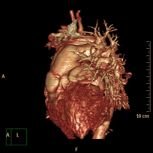 File:Aortopulmonary septal defect (Radiopaedia 41990-45013 3D reconstruction 5).jpg
