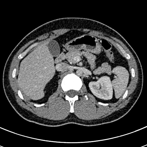 Apical lung mass mimic - neurogenic tumor (Radiopaedia 59918-67521 A 90).jpg