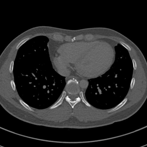 Apical lung mass mimic - neurogenic tumor (Radiopaedia 59918-67521 Axial bone window 57).jpg
