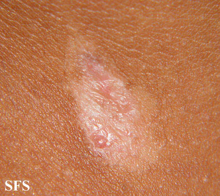 Aplasia Cutis Congenita (Dermatology Atlas 4).jpg