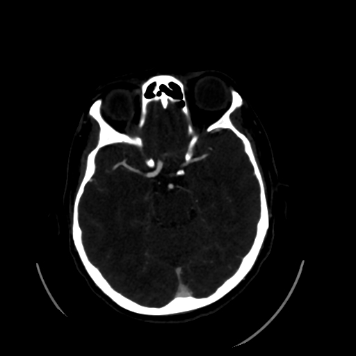 Aplasia of the internal carotid artery (Radiopaedia 61082-68960 A 27).jpg