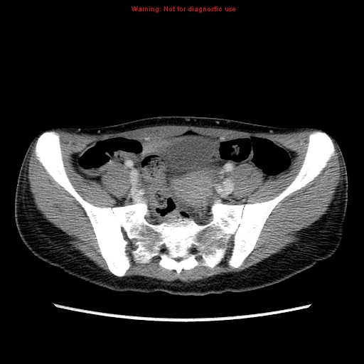 File:Appendiceal abscess (Radiopaedia 13096-13151 A 2).jpg