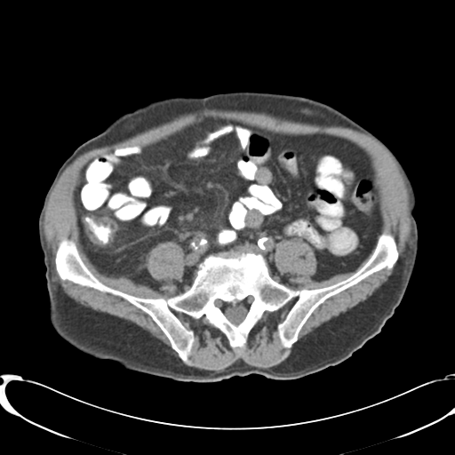 Appendiceal abscesses (Radiopaedia 50999-56542 Axial non-contrast 54).png