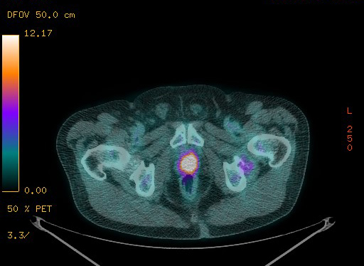 Appendiceal adenocarcinoma complicated by retroperitoneal abscess (Radiopaedia 58007-65041 Axial PET-CT 192).jpg