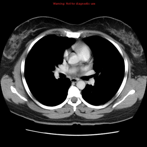 Appendiceal mucinous cystadenoma (Radiopaedia 8263-9111 Axial liver window 1).jpg