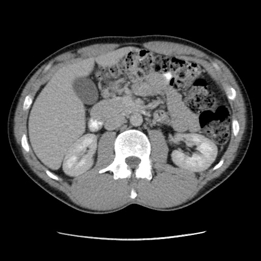 File:Appendicitis complicated by post-operative collection (Radiopaedia 35595-37113 A 27).jpg
