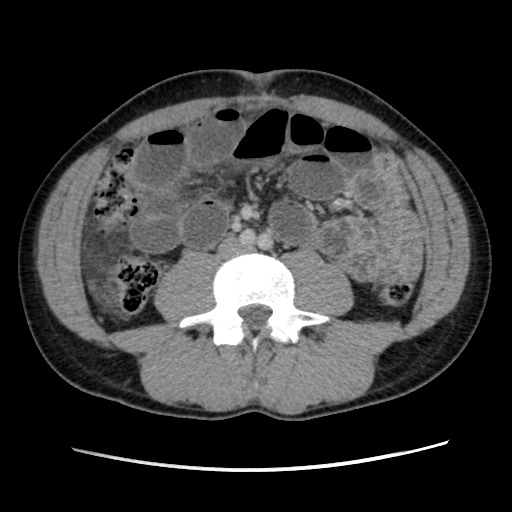 File:Appendicitis complicated by post-operative collection (Radiopaedia 35595-37114 A 48).jpg