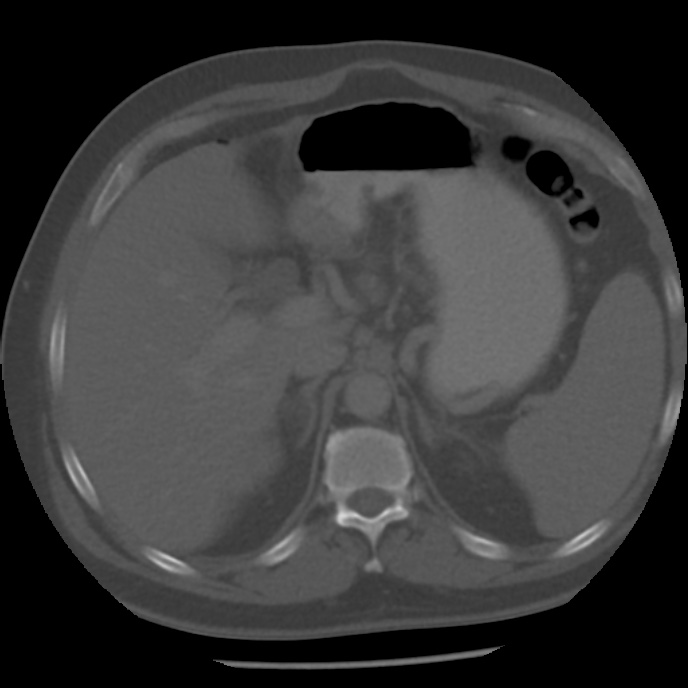 Appendicitis with perforation (Radiopaedia 35790-37342 Axial bone window 12).jpg