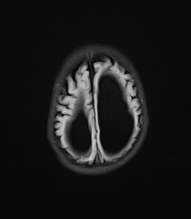 File:Aqueductal stenosis (Radiopaedia 73974-84802 Axial FLAIR 19).jpg